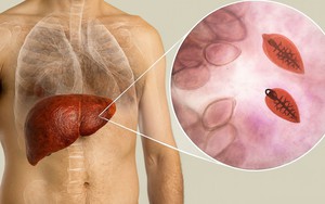 Chủ quán bất ngờ nhận tin gan bị tổn thương nặng vì chính món ăn mình bán mỗi ngày