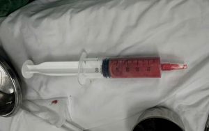 Cảnh báo biến chứng nặng sau khi tiêm chất làm đầy không rõ nguồn gốc