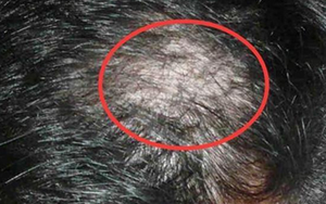 Nữ sinh 14 tuổi rụng sạch tóc vì thói quen này của nhiều người