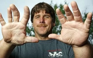 Người đàn ông sở hữu bàn tay to bất thường, sự thật phía sau khiến tất cả kinh ngạc