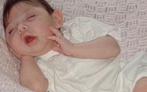 Cô bé sinh ra không có não bây giờ ra sao?