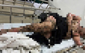 Bị bỏng toàn thân khi quăng câu vướng vào dây điện