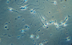 Ca mang thai đầu tiên trên thế giới nhờ phương pháp thu hồi tinh trùng do AI hỗ trợ