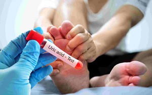 "1 giảm – 2 tăng" giúp kiểm soát acid uric tự nhiên không cần thuốc