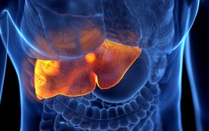 Loại gia vị phá gan chẳng kém rượu bia nếu lạm dụng: Liệu bạn có đang dùng quá nhiều?