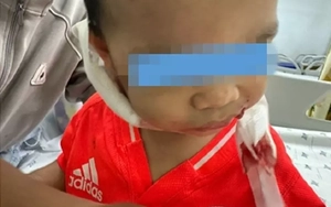 Bé trai 2 tuổi bị chó nhà nuôi cắn nhiều vết trên mặt