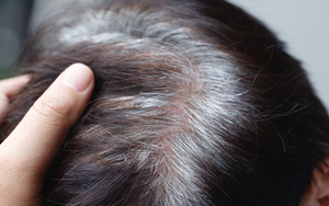 Bác sĩ nói gì về tin “tóc bạc nhiều là dấu hiệu ung thư”?