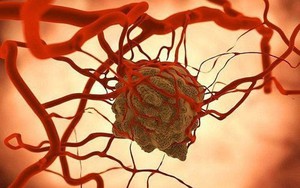 Vượt qua ung thư gan, đây là căn bệnh ung thư có tỷ lệ mắc cao số 1 ở người Việt: Có tính di truyền