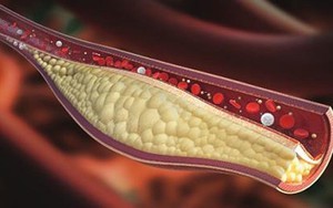 Máu nhiễm mỡ nguy hiểm thế nào?