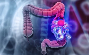 Ung thư đại trực tràng ở người trẻ ngày càng gia tăng, "ác tính mạnh": Nguyên nhân chính là 2 điều này