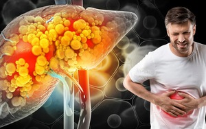 Nghiên cứu khoa học chỉ rõ 1 việc giúp đảo ngược tình trạng gan nhiễm mỡ: Muốn bảo vệ gan, hãy làm ngay