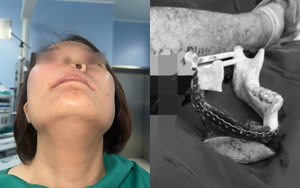 Cô gái 30 tuổi phải cắt bỏ một nửa xương hàm trên: Nguyên nhân được hé lộ