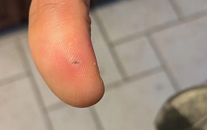 Bị mảnh hành khô găm vào ngón tay, người phụ nữ suýt mất mạng vì điều không ai ngờ tới