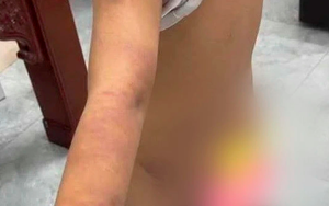 Làm rõ nghi vấn nam sinh lớp 6 bị bạo hành với nhiều vết bầm tím trên cơ thể