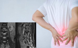 Đau lưng đi khám, người đàn ông Phú Thọ sửng sốt khi xem ảnh MRI