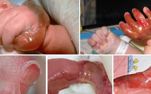 Bé gái tróc da toàn thân vì bệnh lý cực hiếm gặp do đột biến gen