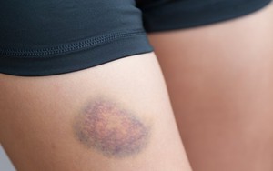 Bị bầm tím ngay cả khi hoạt động bình thường: Nhiều người bỏ qua nhưng BS cảnh báo khả năng mắc bệnh về máu này!