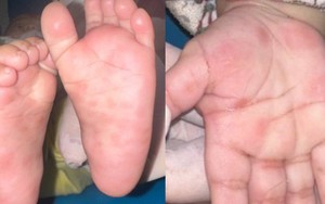 Bé 4 tháng tuổi bị bệnh giang mai bẩm sinh