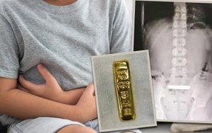 Thỏi vàng nặng 100gr bị cậu bé nuốt vào bụng, phải phẫu thuật để lấy ra