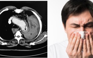 Việt kiều Úc tử vong sau cú hắt xì vì kiên quyết làm 1 điều