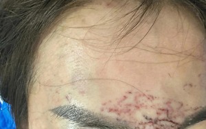 Một phụ nữ ở Cà Mau tố bị xăm mặt, cắt tóc... vì ghen