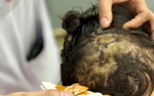Bị chó nhà hơn 20 kg cắn vào vùng đầu, bé gái 5 tuổi phải khâu 10 mũi