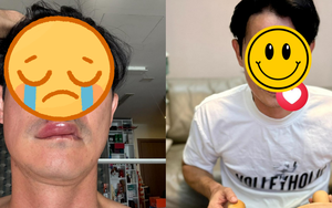 Sao nam Vbiz hoảng hốt vì bị biến dạng mặt: Hé lộ tình trạng nghiêm trọng hiện tại