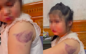 Clip 32 giây vụ học sinh lớp 1 nghi bị cô giáo đánh bầm tím tay vì viết chữ xấu