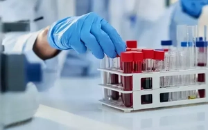 Thử nghiệm công nghệ xét nghiệm máu sử dụng AI chẩn đoán sớm ung thư ruột