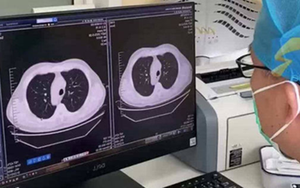 Cảm lạnh và ho, phổi trái của nam sinh đột nhiên "biến mất": Bác sĩ tiết lộ nguyên nhân nhiều người phải cẩn thận