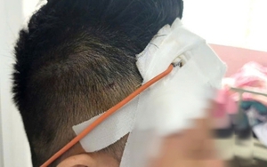 Ngã xe máy, một tháng sau mới lộ chấn thương sọ não