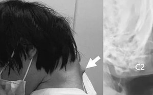 Nhìn điện thoại quá nhiều, nam thanh niên không thể ngẩng đầu