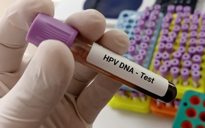 Có cần xét nghiệm virus HPV trước khi tiêm vắc xin HPV không?