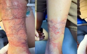 Ôm 'sinh vật lạ' khi chơi ở biển, bé gái phỏng rộp hai tay