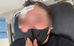 Người phụ nữ đi xe máy "tố" bị tài xế xe bán tải dùng dùi cui vụt vào đầu