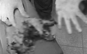 Dập nát bàn tay do nổ điện thoại khi đang sạc