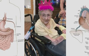 Người phụ nữ sống khỏe mạnh 99 năm với nội tạng đảo ngược trong bụng: Những gì diễn ra trong phòng khám nghiệm thi thể gây chấn động