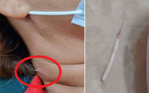 Người phụ nữ vô tình nuốt phải xương cá trong lúc ăn canh, 2 tuần sau chuyện kinh khủng xảy ra