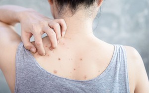 Mọc mụn ở lưng có phải do nóng gan?