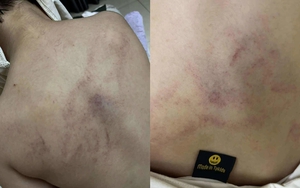 Bé gái mầm non nghi bị bạo hành, đánh tím lưng tại Hà Nội: Gia đình bàng hoàng khi biết lý do