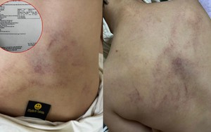 Vụ bé 4 tuổi bị giáo viên đánh, ném vào tường ở Hà Nội: Người mẹ tiết lộ câu nói gây sốc