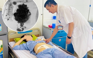 Sau 6 tháng detox bằng chanh muối tại nhà, người phụ nữ ở Bắc Ninh bị hoại tử đại tràng phải mổ cấp cứu