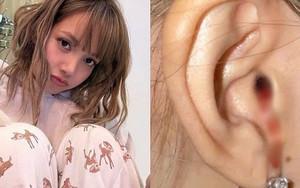 "Máu nhỏ giọt từ tai tôi", tiết lộ của Lisa (BlackPink) khiến nhiều người lo lắng: Chuyên gia chỉ ra nguyên nhân