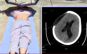 Tắm nắng cho khỏe, người phụ nữ bị xuất huyết não, hôn mê