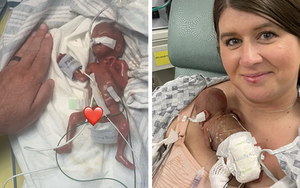 Em bé "sinh non nhất thế giới" nặng 285 gam, dài 24cm khi mới chào đời, sau 1 năm giờ ra sao?