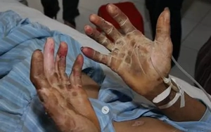 Xẻ thịt lợn không đồ bảo hộ, người đàn ông đối mặt nguy cơ mất thính lực suốt đời