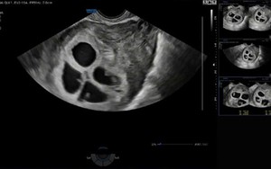 Cực hiếm gặp: Bệnh viện Phụ Sản Hà Nội ghi nhận 1 sản phụ mang thai 4 tự nhiên, tỷ lệ chỉ khoảng 1/700.000 - 800.000 ca