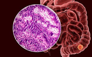 Phát hiện ung thư đại tràng giai đoạn 3 từ 1 triệu chứng xuất hiện 10 lần/ ngày