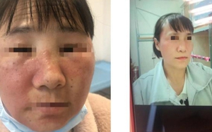 Người phụ nữ cấp cứu với khuôn mặt biến dạng: Bác sĩ thốt lên "tuyệt đối đừng dùng thứ này"