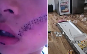 Mở tủ lạnh, bé trai 6 tuổi phải khâu 38 mũi trên mặt